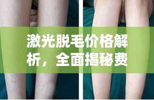 激光脱毛价格解析，全面揭秘费用因素！